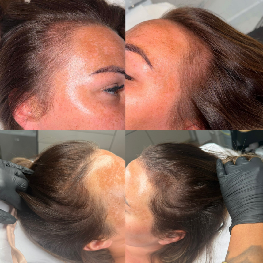 Collage showing the hairline and temple areas